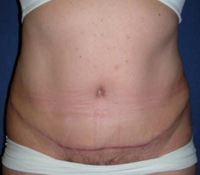 After Image: 4 Months Traditional Abdominoplasty Post-Op - front