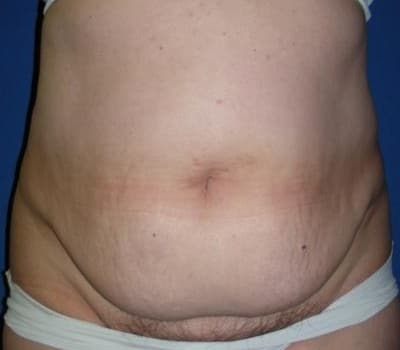Before Image: 4 Months Traditional Abdominoplasty Post-Op - front