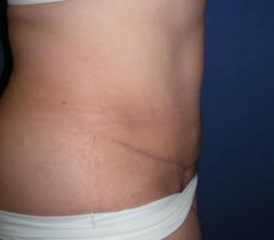 After Image: 4 Months Traditional Abdominoplasty Post-Op - other