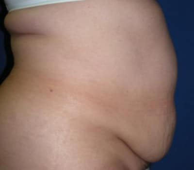 Before Image: 4 Months Traditional Abdominoplasty Post-Op - other