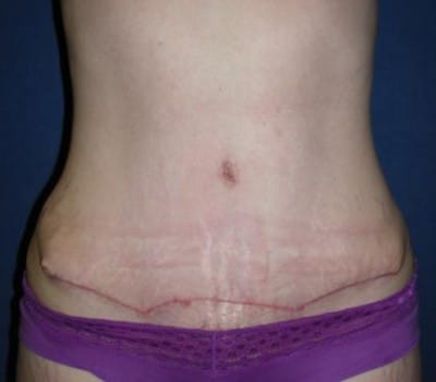After Image: Abdominoplasty Flank Lipo - front