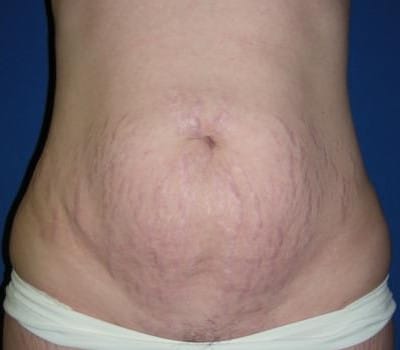 Before Image: Abdominoplasty Flank Lipo - front