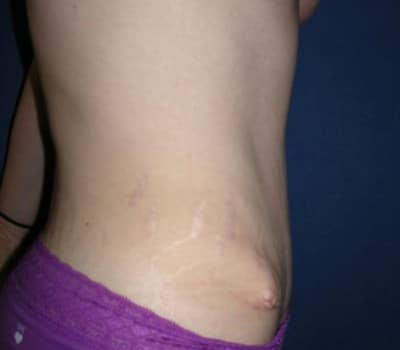 After Image: Abdominoplasty Flank Lipo - other