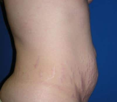 Before Image: Abdominoplasty Flank Lipo - other