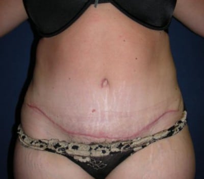 After Image: 63 Year Old Abdominoplasty With Flank Lipo - front