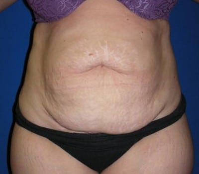 Before Image: 63 Year Old Abdominoplasty With Flank Lipo - front