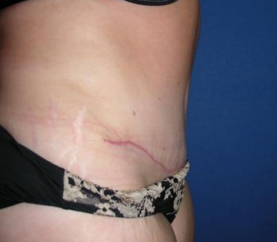 After Image: 63 Year Old Abdominoplasty With Flank Lipo - other