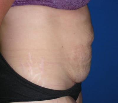 Before Image: 63 Year Old Abdominoplasty With Flank Lipo - other