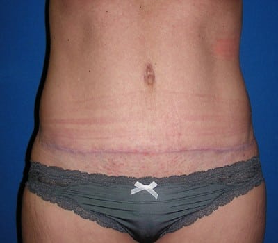 After Image: Abdominoplasty With Bilateral Breast Enhancement & Lift - front