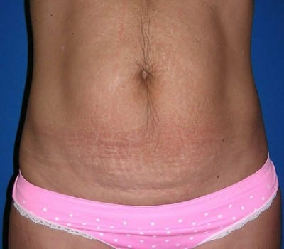 Before Image: Abdominoplasty With Bilateral Breast Enhancement & Lift - front