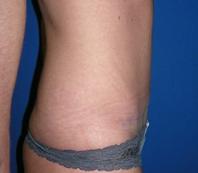After Image: Abdominoplasty With Bilateral Breast Enhancement & Lift - other