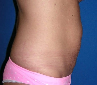 Before Image: Abdominoplasty With Bilateral Breast Enhancement & Lift - other