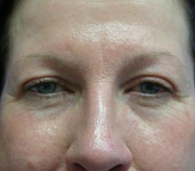 After Image: Adult Female 6 Weeks Post-Op - other