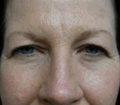 Before Image: Adult Female 6 Weeks Post-Op - other