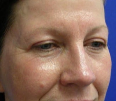 After Image: Adult Female 6 Weeks Post-Op - other