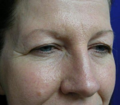 Before Image: Adult Female 6 Weeks Post-Op - other