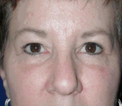 After Image: Brow Lift With Upper & Lower Eyelid Lift - other