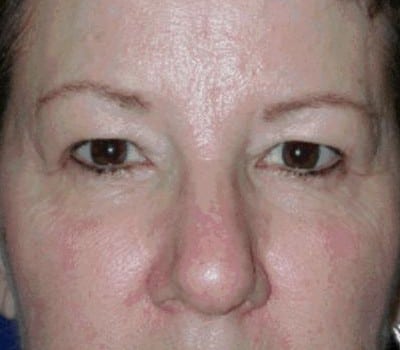 Before Image: Brow Lift With Upper & Lower Eyelid Lift - other