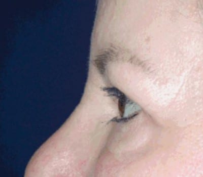 After Image: Brow Lift With Upper & Lower Eyelid Lift - other