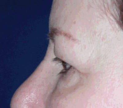 Before Image: Brow Lift With Upper & Lower Eyelid Lift - other