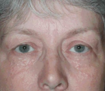 Before Image: 58 YearS Old - other