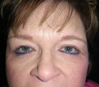 After Image: Blepharoplasties With Brow & Cheek Lifts - other