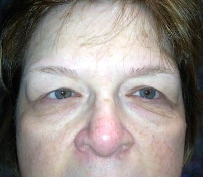 Before Image: Blepharoplasties With Brow & Cheek Lifts - other