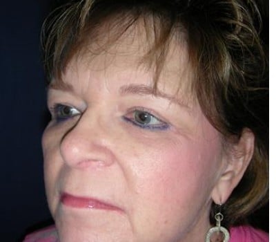 After Image: Blepharoplasties With Brow & Cheek Lifts - other