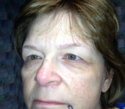 Before Image: Blepharoplasties With Brow & Cheek Lifts - other