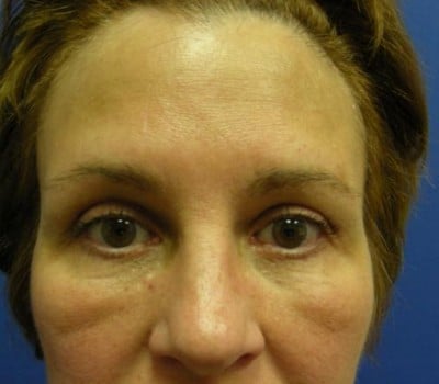 After Image: Browlift With Simultaneous Bilateral Eyelid Lifts - front