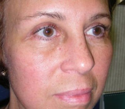 After Image: Browlift With Simultaneous Bilateral Eyelid Lifts - right-front-oblique