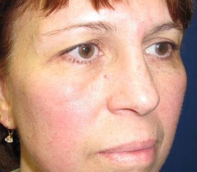 Before Image: Browlift With Simultaneous Bilateral Eyelid Lifts - right-front-oblique