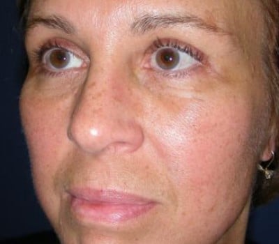 After Image: Browlift With Simultaneous Bilateral Eyelid Lifts - left-front-oblique