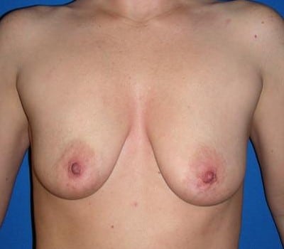 Before Image: 250cc silicone gel implants - front