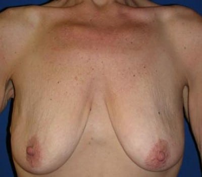 Before Image: 325cc silicone gel submuscular implants - front