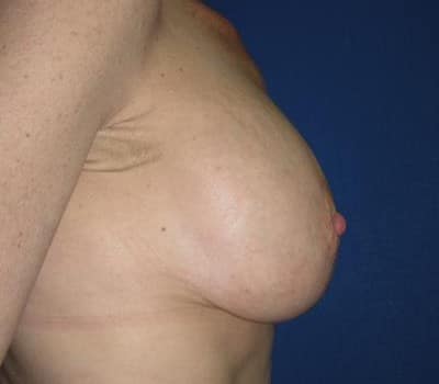 After Image: 325cc silicone gel submuscular implants - other