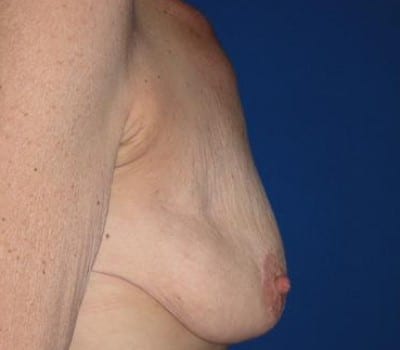 Before Image: 325cc silicone gel submuscular implants - other