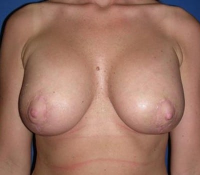 After Image: lift & implant - front