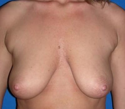 Before Image: lift & implant - front