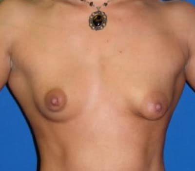 Before Image: tuberous breast deformity correction - front