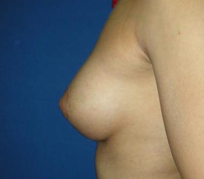 After Image: tuberous breast deformity correction - other