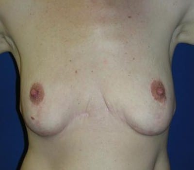 Before Image: 310cc saline implants - front