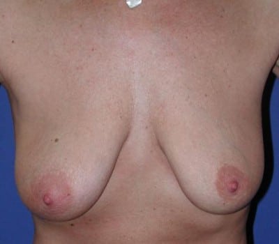 Before Image: 50 years old - front