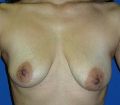 Before Image: 339cc silicone gel implants - front