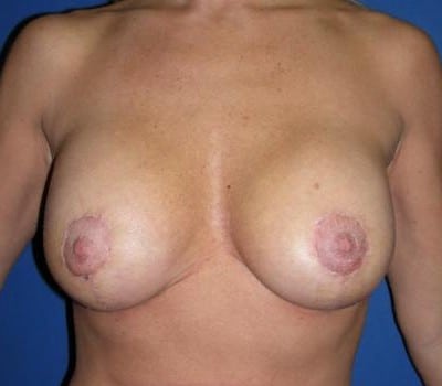 After Image: 38 year old female S/P 2 pregnancies - front