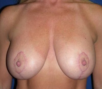 After Image: lifted breasts & amplified volume - front