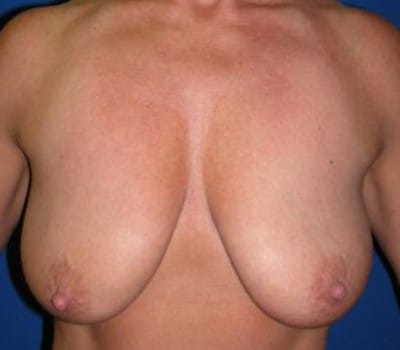 Before Image: lifted breasts & amplified volume - front