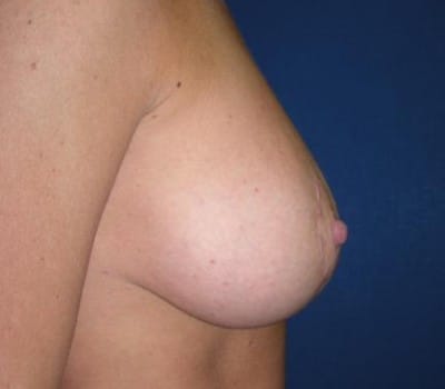 After Image: lifted breasts & amplified volume - other