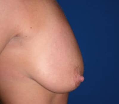 Before Image: lifted breasts & amplified volume - other