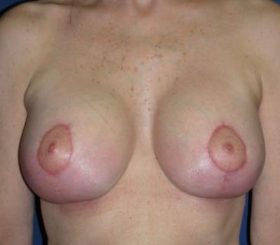 After Image: improved shape & size - front